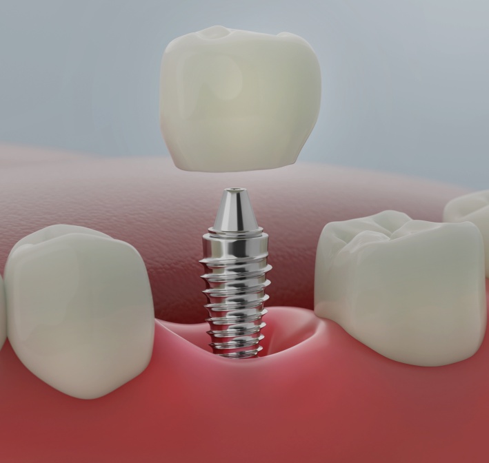 Treatment - Lockswood Dental